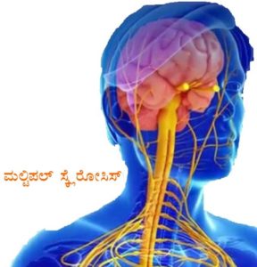 multiple-sclerosis ಮಲ್ಟಿಪಲ್ ಸ್ಕ್ಲೆರೋಸಿಸ್ - ಕೆರಳಿಸಿ, ನರಳಿಸುವ ನರರೋಗ