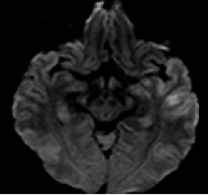 MRI-picture-showing-early-stroke-changes-
