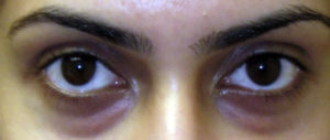 dark-circles eye problem ಕಣ್ಣುಸುತ್ತಲಿನ ಕಪ್ಪು ಅಥವಾ ಡಾರ್ಕ್ ಸರ್ಕಲ್