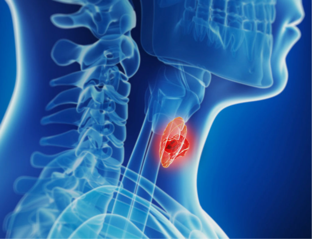 thyroid-cancer-
