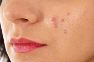 pimples ಪಿಂಪಲ್ಸ್ ಹಾಗೂ ಅದರ ನಿವಾರೋಣೋಪಾಯಗಳು