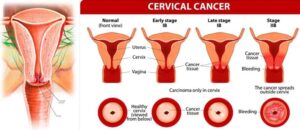 cervical-cancer ಕ್ಯಾನ್ಸರ್ ಜಾಗೃತಿ ದಿನ - ನವಂಬರ್- 7 : ಕ್ಯಾನ್ಸರ್ ಗುಣಪಡಿಸಲಾಗದ ಖಾಯಿಲೆಯಲ್ಲ.