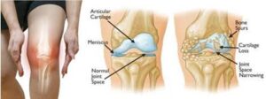 osteo-arthritis ಆಸ್ಟಿಯೋ ಅರ್ಥ್ರೈಟಿಸ್ ಅಥವಾ ಮಂಡಿನೋವು : ಆಹಾರ, ವ್ಯಾಯಾಮ, ಚಿಕಿತ್ಸೆಗಳ ಮೂಲಕ ಶಾಶ್ವತ ಪರಿಹಾರ