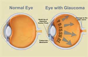 glaucoma /ಗ್ಲಾಕೋಮಾ ಮಾರಣಾಂತಿಕ ರೋಗವಲ್ಲ- ಚಿಕಿತ್ಸೆ  ನೀಡದಿದ್ದಲ್ಲಿ ಅಂಧತ್ವಕ್ಕೆ ನಾಂದಿ