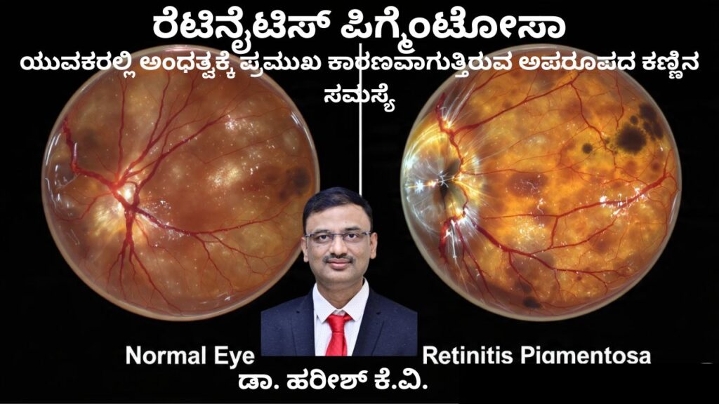 Retinitis Pigmentosa Yuvakaralli andhatvakke kāraṇavāguttiruva kaṇṇina samasye #abhisheknethradhama #drhareeshkv #eyehospital #yelahanka #vydyaloka #healthvision