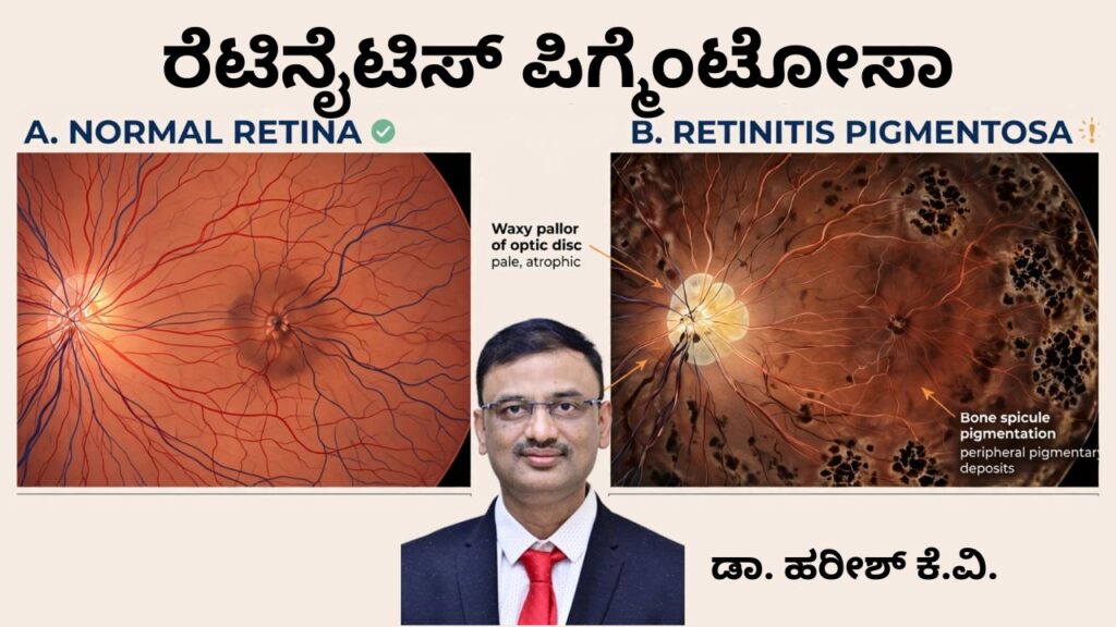 retinitis pigmentosa yuvakaralli andhatvakke pramukha kāraṇa Dr Hareesh K V, #abhisheknethradhama #vydyaloka #healthvision #drhareesh